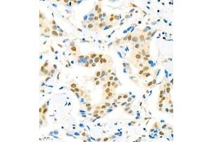 Immunohistochemistry of paraffin embedded human breast cancer using Suv39h2 (ABIN7075771) at dilution of 1:2000 (400x lens) (SUV39H2 anticorps)