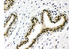 Anti-p95 NBS1 Picoband antibody, IHC(P) IHC(P): Human Mammary Cancer Tissue