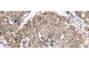 Immunohistochemistry of paraffin-embedded Human liver cancer tissue using RPL18 Polyclonal Antibody at dilution of 1:70(x200)