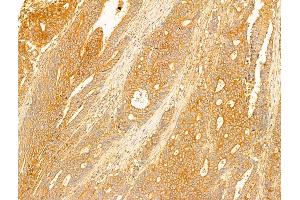 ABIN6263515 and ABIN6273059 at 1/100 staining Human colorectal cancer by IHC-P. (NAPRT1 anticorps  (Internal Region))