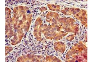 Immunohistochemistry of paraffin-embedded human pancreatic cancer using ABIN7156663 at dilution of 1:100 (IFIT1 anticorps  (AA 1-181))