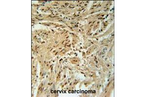 BLOC1S2 Antibody immunohistochemistry analysis in formalin fixed and paraffin embedded human cervix carcinoma followed by peroxidase conjugation of the secondary antibody and DAB staining. (BLOC1S2 anticorps  (AA 14-40))