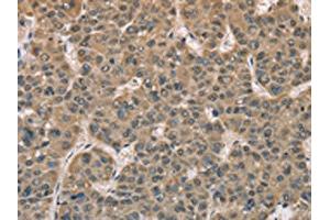 The image on the left is immunohistochemistry of paraffin-embedded Human liver cancer tissue using ABIN7129149(DACH2 Antibody) at dilution 1/40, on the right is treated with fusion protein. (DACH2 anticorps)