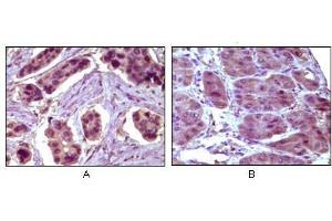 Immunohistochemical analysis of paraffin-embedded human breast carcinoma (A) and liver carcinoma (B), showing cytoplasmic localization using BCL10 antibody with DAB staining. (BCL10 anticorps)