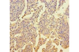 Immunohistochemistry of paraffin-embedded human cervical cancer using ABIN7176469 at dilution of 1:100 (ZNF662 anticorps  (AA 182-452))