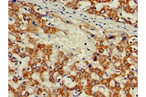 Immunohistochemistry of paraffin-embedded human liver cancer using ABIN7176539 at dilution of 1:100 (Zinc Finger Protein 816A (ZNF816A) (AA 1-200) anticorps)