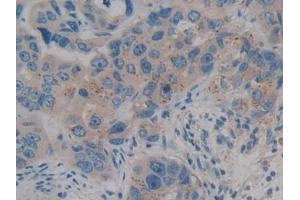 Detection of CIDEC in Human Breast cancer Tissue using Polyclonal Antibody to Cell Death Inducing DFFA Like Effector C (CIDEC)