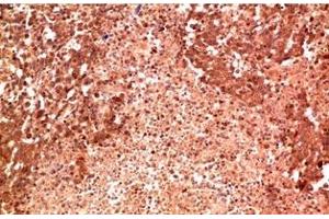 Immunohistochemistry of paraffin-embedded Human lung carcinoma tissue using P38 Monoclonal Antibody at dilution of 1:200. (MAPK14 anticorps)