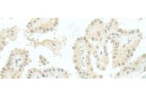 Immunohistochemistry of paraffin-embedded Human thyroid cancer tissue using ESRP2 Polyclonal Antibody at dilution of 1:95(x200) (ESRP2 anticorps)