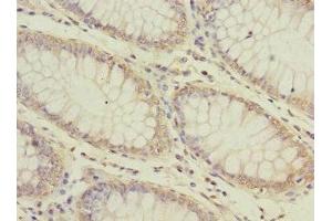Immunohistochemistry of paraffin-embedded human colon cancer using ABIN7175240 at dilution of 1:100