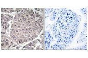 Immunohistochemistry analysis of paraffin-embedded human liver carcinoma tissue using APOL4 antibody. (Apolipoprotein L 4 anticorps  (C-Term))