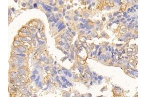 Detection of CK10 in Human Colorectal cancer Tissue using Polyclonal Antibody to Cytokeratin 10 (CK10)