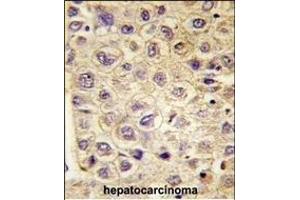 Formalin-fixed and paraffin-embedded human hepatocarcinoma tissue reacted with TYRO3 Antibody (ABIN387820 and ABIN2843907) , which was peroxidase-conjugated to the secondary antibody, followed by DAB staining.