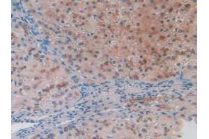 IHC-P analysis of Human Liver Cancer Tissue, with DAB staining. (BACE2 anticorps  (AA 230-396))