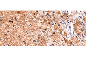 Immunohistochemistry of paraffin-embedded Human liver cancer tissue using TSEN2 Polyclonal Antibody at dilution of 1:80(x200) (TSEN2 anticorps)