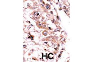Formalin-fixed and paraffin-embedded human hepatocellular carcinoma tissue reacted with PPP3CC polyclonal antibody  , which was peroxidase-conjugated to the secondary antibody, followed by AEC staining. (PPP3CC anticorps  (C-Term))