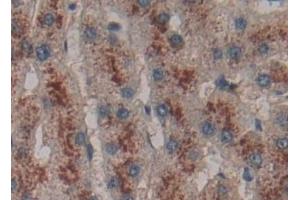 Detection of PP13 in Human Liver cancer Tissue using Polyclonal Antibody to Placental Protein 13 (PP13)