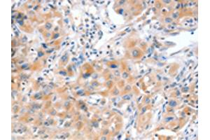 The image on the left is immunohistochemistry of paraffin-embedded Human lung cancer tissue using ABIN7128172(ACOX2 Antibody) at dilution 1/20, on the right is treated with fusion protein. (Acox2 anticorps)