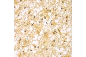 Immunohistochemistry of paraffin-embedded human brain cancer using PAK6 antibody.