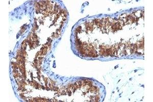 Formalin-fixed, paraffin-embedded human testicular carcinoma stained with Major Vault Protein antibody (1032). (MVP anticorps)