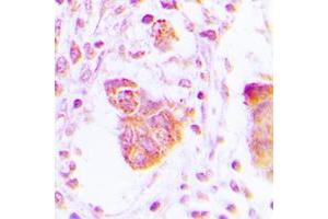 Immunohistochemical analysis of MOV10L1 staining in human lung cancer formalin fixed paraffin embedded tissue section.