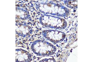 Immunohistochemistry of paraffin-embedded Human colon using SND1 Rabbit pAb (ABIN6129741, ABIN6148197, ABIN6148199 and ABIN6221577) at dilution of 1:100 (40x lens). (SND1 anticorps  (AA 26-285))