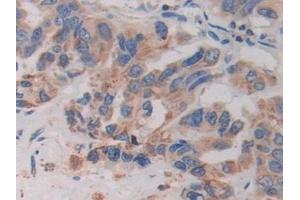 Detection of CYR61 in Human Breast cancer Tissue using Polyclonal Antibody to Cysteine Rich Protein, Angiogenic Inducer 61 (CYR61)