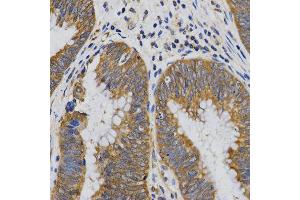 Immunohistochemistry of paraffin-embedded human rectal cancer tissue using PIBF1 antibody at dilution of 1:200 (x400 lens). (PIBF1 anticorps)