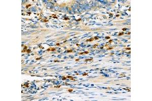 Immunohistochemistry of paraffin embedded human gastric cancer using CD307 (ABIN7073931) at dilution of 1:600 (300x lens) (FCRL5 anticorps)