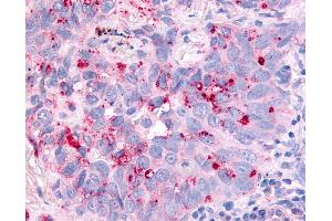 Anti-CDC7 antibody IHC of human Lung, Non-Small Cell Carcinoma.