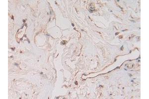 Detection of b2M in Human Breast cancer Tissue using Polyclonal Antibody to Beta-2-Microglobulin (b2M)