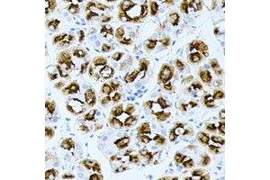 Immunohistochemical analysis of BPGM staining in human gastric cancer formalin fixed paraffin embedded tissue section.