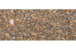 Immunohistochemistry of paraffin-embedded Human ovarian cancer tissue using XPR1 Polyclonal Antibody at dilution of 1:45(x200)