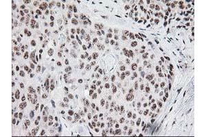 Immunohistochemical staining of paraffin-embedded Adenocarcinoma of Human breast tissue using anti-MGLL mouse monoclonal antibody. (MGLL anticorps)