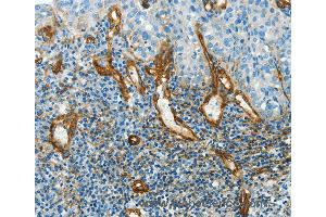 Immunohistochemistry of Human cervical cancer using CAV1 Polyclonal Antibody at dilution of 1:40
