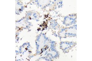 Immunohistochemistry of paraffin-embedded human thyroid cancer using CORO1A Rabbit pAb (ABIN6133495, ABIN6138903, ABIN6138904 and ABIN6224969) at dilution of 1:100 (40x lens).