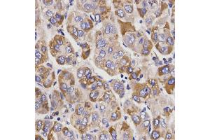 Immunohistochemistry of paraffin-embedded human liver cancer using UGT1A9 antibody. (UGT1A9 anticorps)