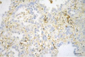 Immunohistochemistry was performed on paraffin-embedded human lung adenocarcinoma using beta actin antibody (ABIN7797467), 1:200). (Recombinant beta Actin anticorps)