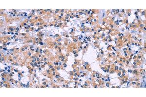 Immunohistochemistry of paraffin-embedded Human thyroid cancer tissue using DUSP22 Polyclonal Antibody at dilution 1:60 (DUSP22 anticorps)