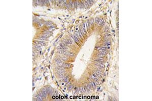 Formalin-fixed and paraffin-embedded human colon carcinomareacted with AKR1B1 polyclonal antibody , which was peroxidase-conjugated to the secondary antibody, followed by AEC staining. (AKR1B1 anticorps  (Internal Region))