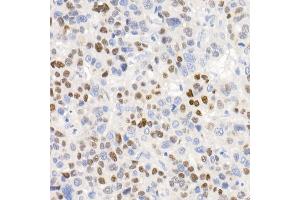 Immunohistochemistry of paraffin-embedded human liver cancer using [KO Validated] CDKN1A/p21CIP1 Rabbit mAb (ABIN7266599) at dilution of 1:100 (40x lens).