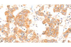 Immunohistochemistry of paraffin-embedded Human breast cancer using PRDX2 Polyclonal Antibody at dilution of 1:80 (Peroxiredoxin 2 anticorps)