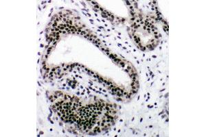 Anti-NRF1 antibody, IHC(P) IHC(P): Human Mammary Cancer Tissue