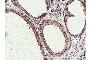 Immunohistochemical staining of paraffin-embedded Human breast tissue using anti-ILVBL mouse monoclonal antibody. (ILVBL anticorps)