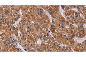 Immunohistochemistry of paraffin-embedded Human liver cancer tissue using CALCA Polyclonal Antibody at dilution 1:40 (CGRP anticorps)
