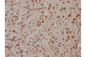 IHC image of ABIN7166521 diluted at 1:300 and staining in paraffin-embedded human glioma cancer performed on a Leica BondTM system.