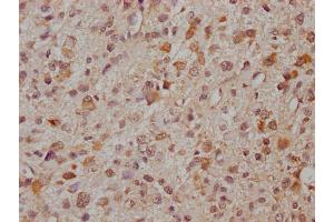 IHC image of ABIN7166521 diluted at 1:300 and staining in paraffin-embedded human glioma cancer performed on a Leica BondTM system. (PCDHa8 anticorps  (AA 719-922))
