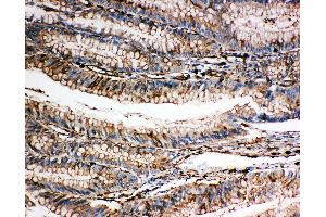 Anti-Gelsolin antibody, IHC(P) IHC(P): Human Intestinal Cancer Tissue