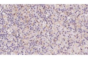 ABIN6273082 at 1/100 staining Human lymph cancer tissue by IHC-P. (Tropomodulin 4 anticorps  (Internal Region))