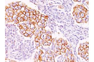 Formalin-fixed, paraffin-embedded human Breast Carcinoma stained with Phosphotyrosine Mouse Monoclonal Antibody (PY20). (Phosphotyrosine anticorps)